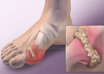 النقرس– داء الملوك