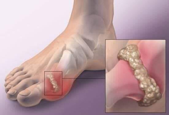 النقرس– داء الملوك