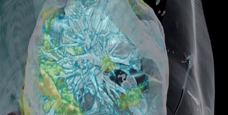 كل ما تريد معرفته …عن ما يسببه كورونا من نقص الاكسجين فى الدم