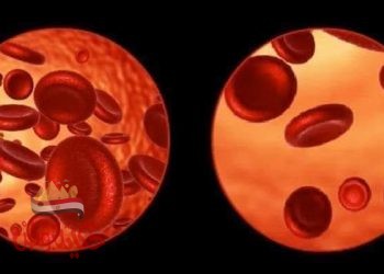 كيف تعالح فقر الدم بالغذاء والاعشاب