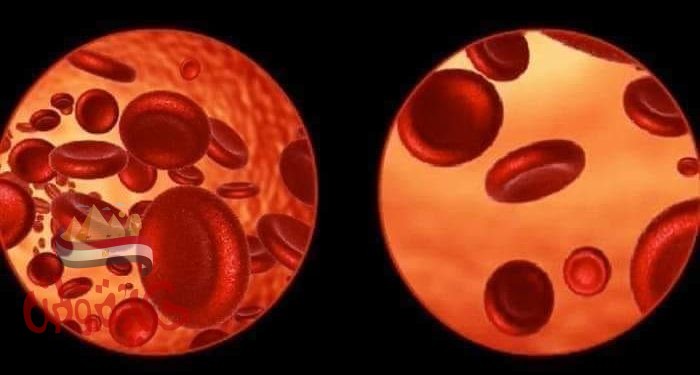 كيف تعالح فقر الدم بالغذاء والاعشاب