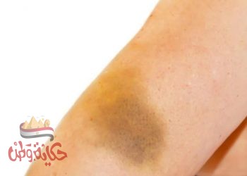 سبب ظهور لون بنفسجي بعد سحب الدم