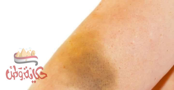 سبب ظهور لون بنفسجي بعد سحب الدم