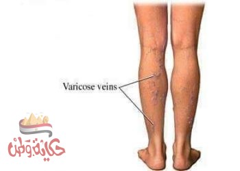 علاج الدوالي بالأعشاب