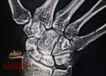 إجراء عملية تغيير مفصل للمرة الأولي بمستشفي منيا القمح وعمليات عظام متقدمة أخري