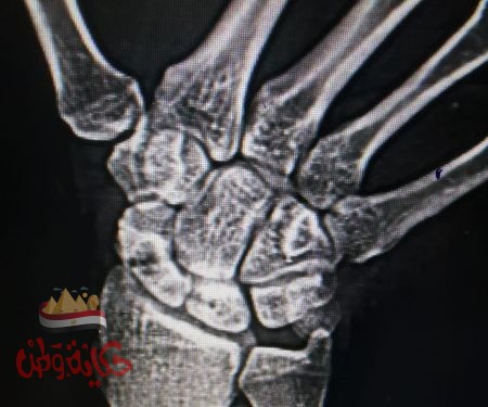 إجراء عملية تغيير مفصل للمرة الأولي بمستشفي منيا القمح وعمليات عظام متقدمة أخري