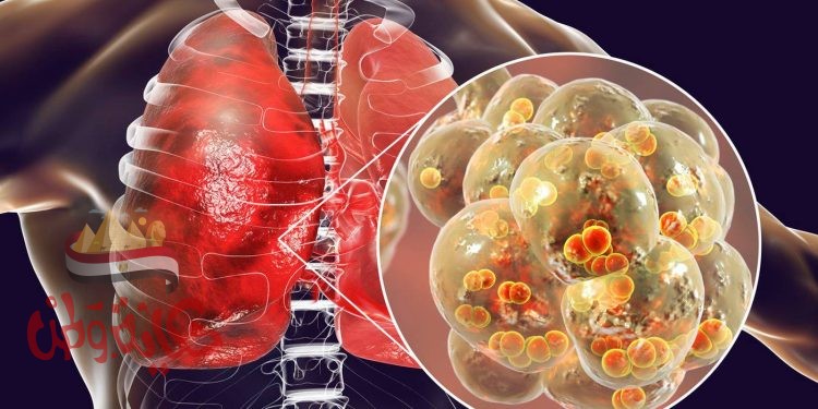 وباء جديد يسبب ازمة عالمية ثانية