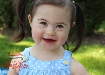 متلازمة داون (Down syndrome