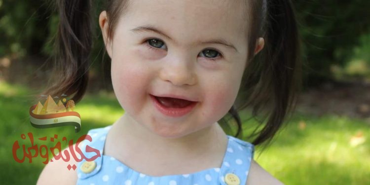 متلازمة داون (Down syndrome