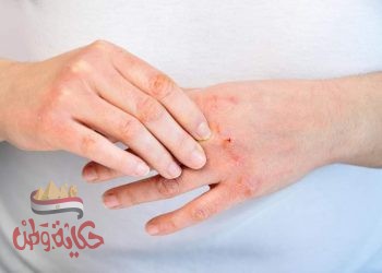 الخبراء في اليوم العالمي للصدفية .. مرض مناعي غير معدي يصيب اكثر من مليون مواطن مصرى