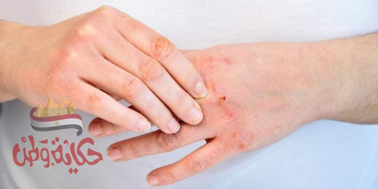 الخبراء في اليوم العالمي للصدفية .. مرض مناعي غير معدي يصيب اكثر من مليون مواطن مصرى