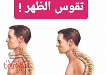 تقوس الظهر و أسبابه وأعراضه وطرق الوقاية والعلاج