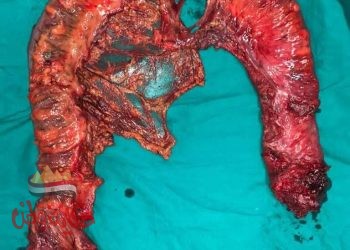 إستئصال زوائد لحمية تهدد بالإصابة بالسرطان بالقولون