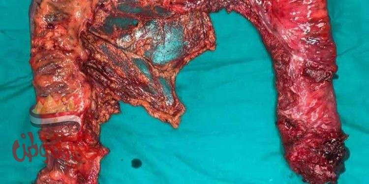 إستئصال زوائد لحمية تهدد بالإصابة بالسرطان بالقولون