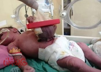 أطباء الاحرار في الزقازيق ينقذون حياة رضيع ولد بإمعاء خارجيه