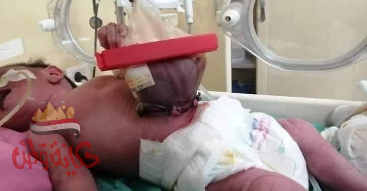 أطباء الاحرار في الزقازيق ينقذون حياة رضيع ولد بإمعاء خارجيه