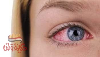 أسباب إحمرار العين