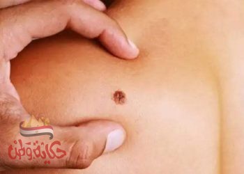 تعرف إلى الفرق مابين الشامات الطبيعية والسرطانية