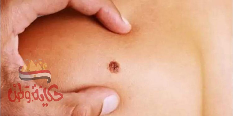 تعرف إلى الفرق مابين الشامات الطبيعية والسرطانية
