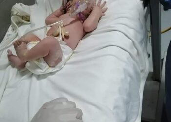 اجراء 17 عملية قيصرية لسيدات مصابات بكورونا.