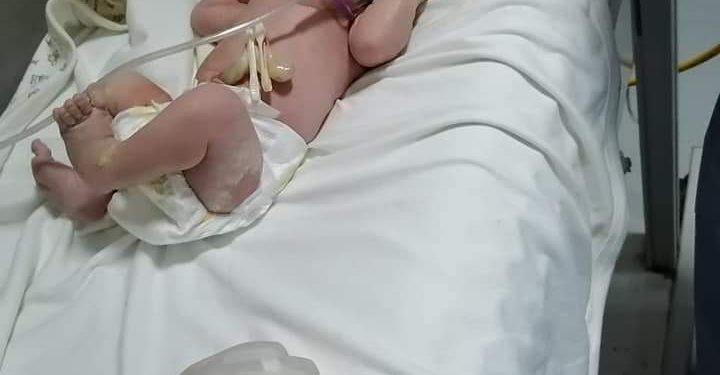 اجراء 17 عملية قيصرية لسيدات مصابات بكورونا.