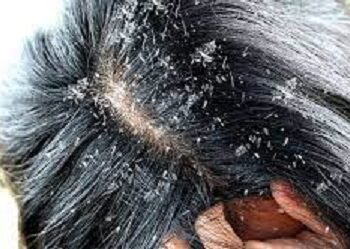 مشكلة القشره بالرأس