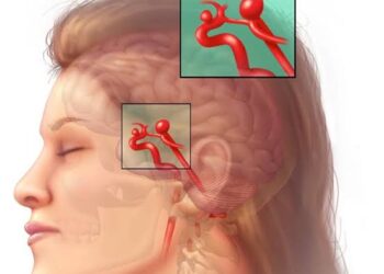 أعراض تمدد الأوعية الدموية الدماغية