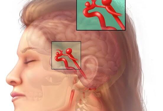 أعراض تمدد الأوعية الدموية الدماغية