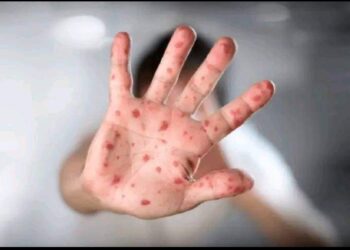 وباء عالمي جديد يضرب أمريكا وأوروبا وينتشر حول العالم. 