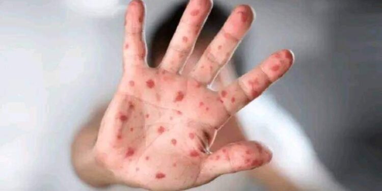 وباء عالمي جديد يضرب أمريكا وأوروبا وينتشر حول العالم.