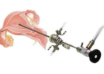 أهمية منظار الرحم