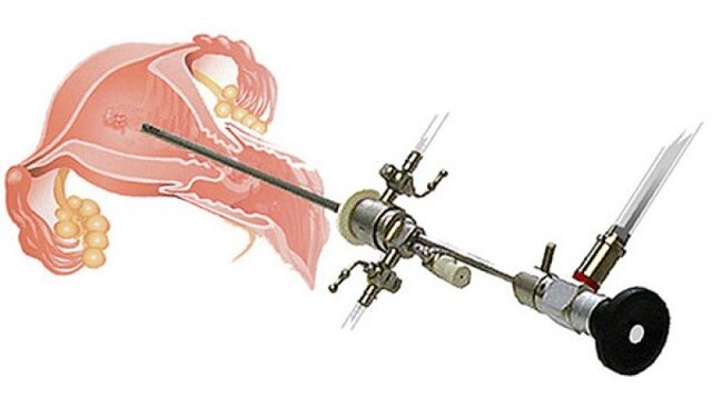 أهمية منظار الرحم