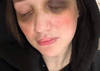 هدير الشناوى تتعرض للضرب المبرح من مجهول.. «أعرف الحكاية»