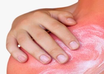 ماذا تفعل عندما تتعرض لحروق شمس الصيف