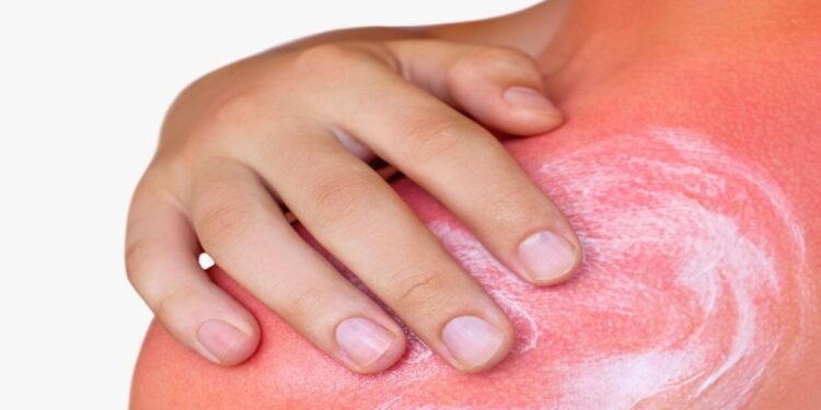 ماذا تفعل عندما تتعرض لحروق شمس الصيف