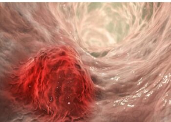 بعض الاطعمة تمنحك وقاية من سرطان الأمعاء