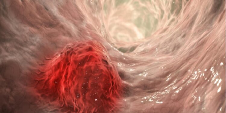 بعض الاطعمة تمنحك وقاية من سرطان الأمعاء