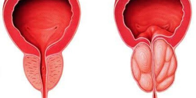 مشاكل ما بعد الخمسين عند الرجال رعب البروستات