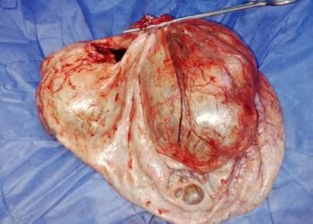 إستئصال ورم داخل تجويف بطن إحدى الفتيات يزن ٧ كيلو جرام 