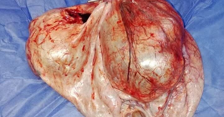 إستئصال ورم داخل تجويف بطن إحدى الفتيات يزن ٧ كيلو جرام